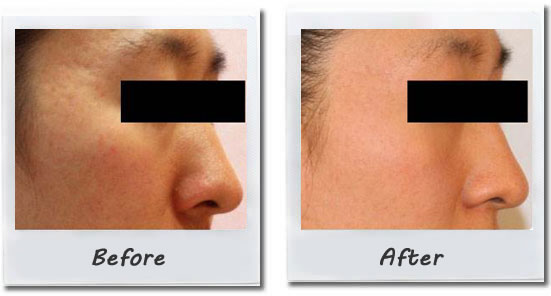 Acne and Acne Scars