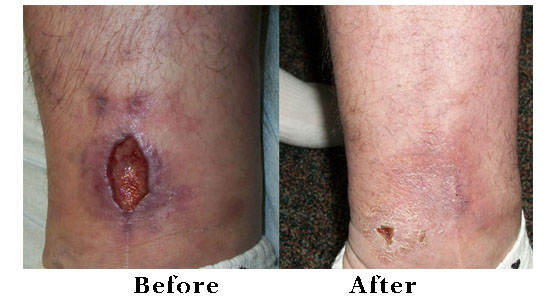 Leg Ulcer