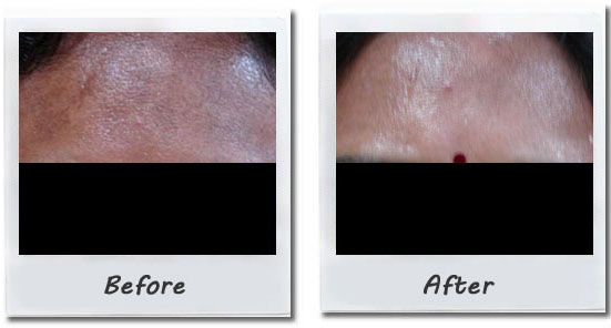 Mesotherapy