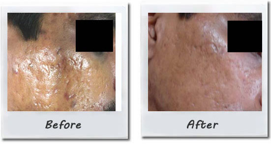 Mesotherapy