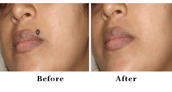 Mole Removal