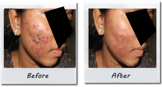 Acne and Acne Scars