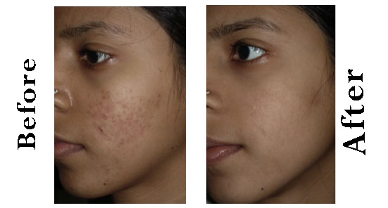 Derma Roller