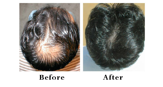 Hair loss prevention