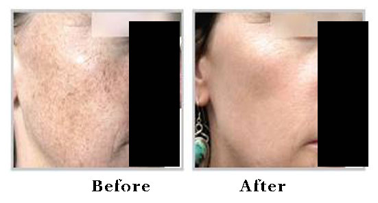 IPL or Intense Pulsed Light