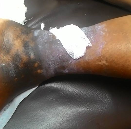 Non Healing Chronic Leg Ulcer